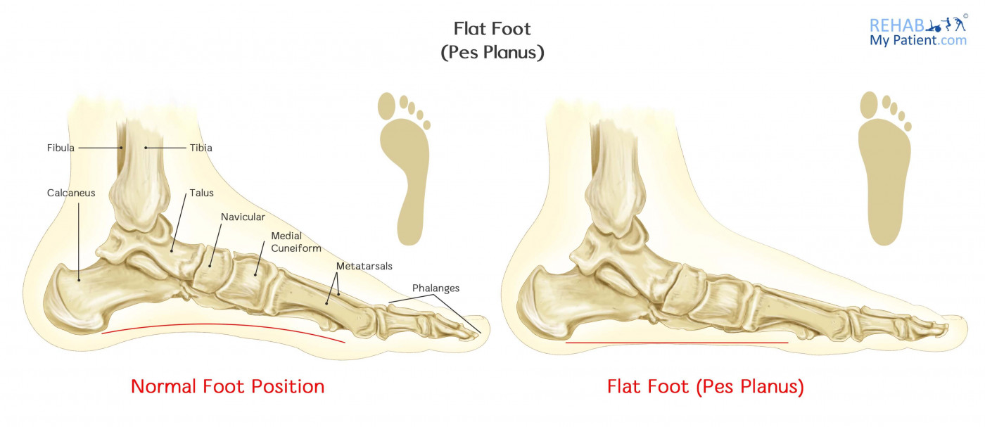 Foot Pronation During Movement