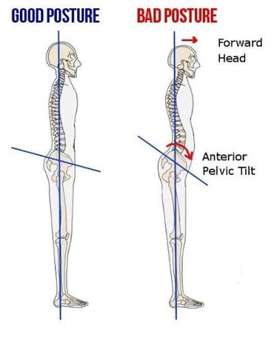 Excessive Anterior Pelvic Tilt