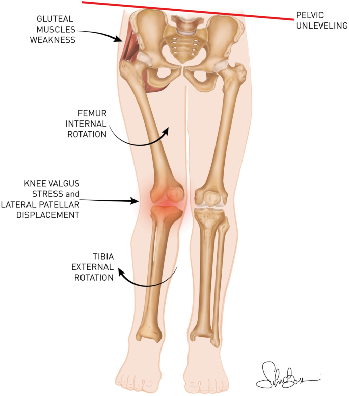 Valgus Knee (Knee Moving Inward)