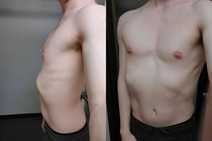 Rib Flare